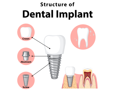 Dental Implants Fort Wayne IN